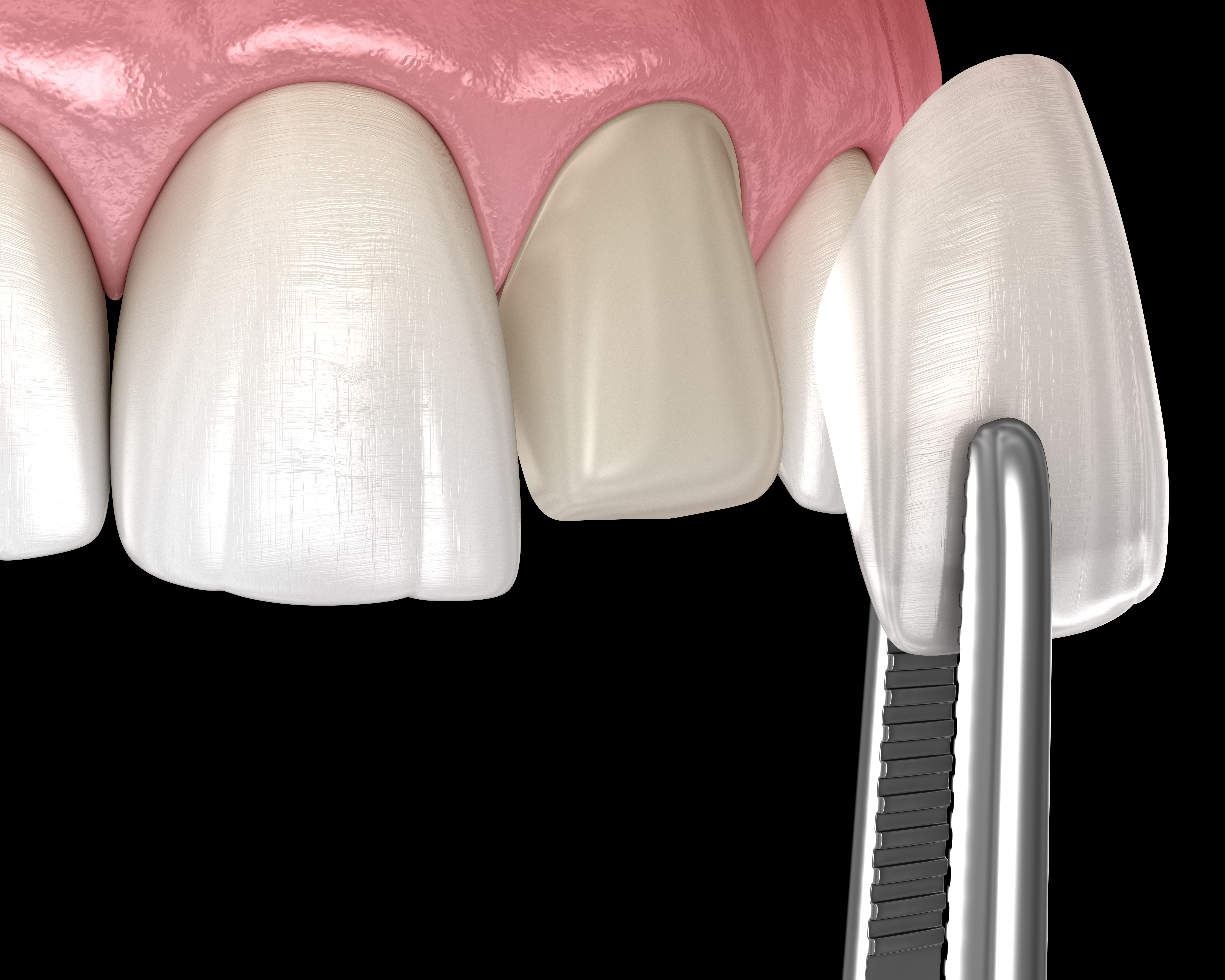 Veneers für ein strahlendes Lächeln